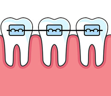 Braces / Orthodontic Treatment