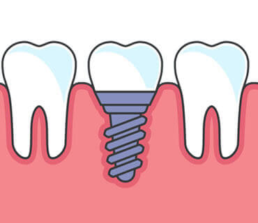 Dental Implants