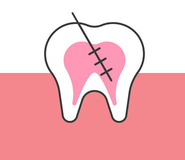 Root Canal Treatment