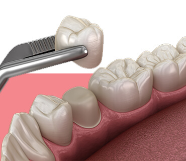 Tooth Preparation