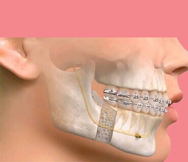 Maxillofacial Trauma Management 