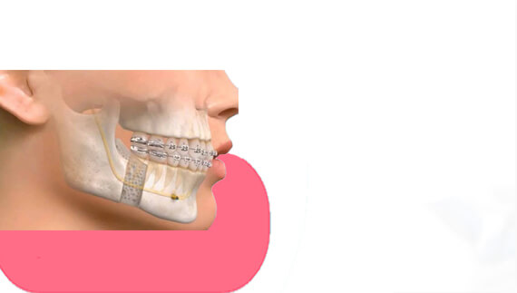 Maxillofacial Trauma