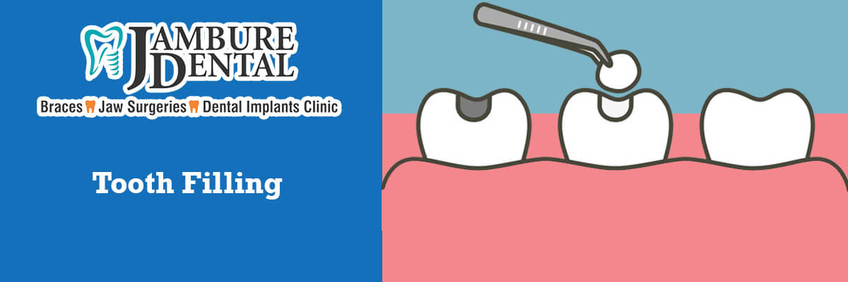 Tooth Filling- JAMBURE DENTAL CLINIC