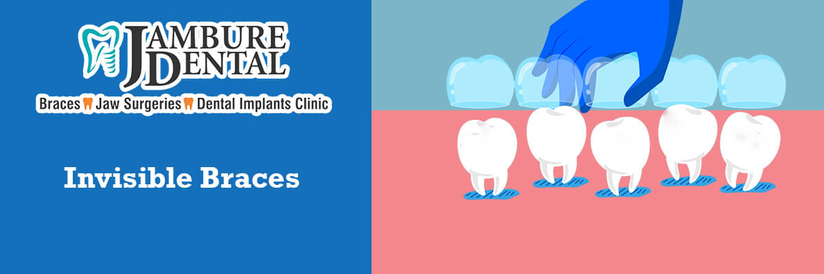 Invisible Braces - JAMBURE DENTAL CLINIC