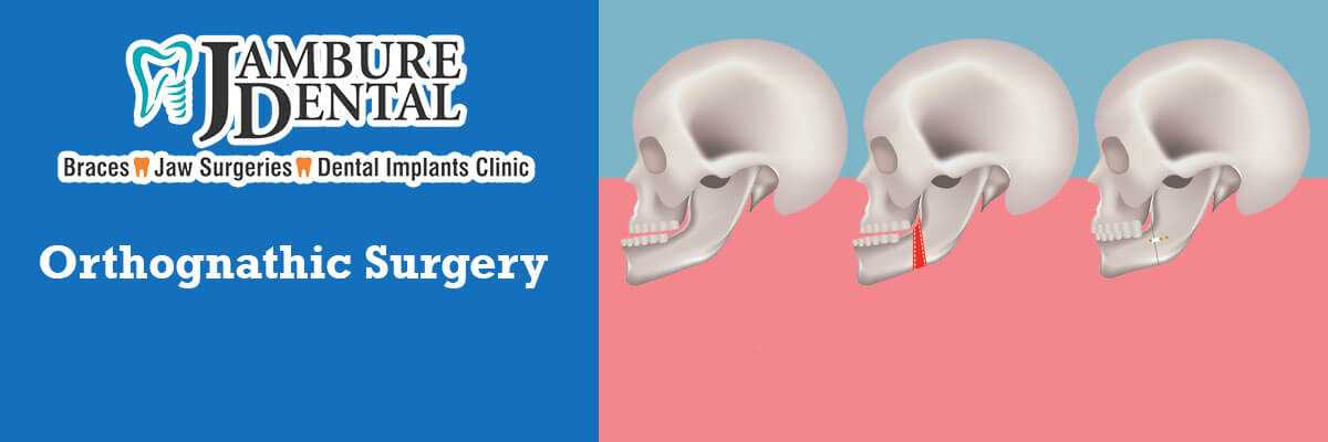 Orthognathic Surgeries - JAMBURE DENTAL CLINIC