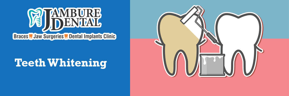 teeth whitening- JAMBURE DENTAL CLINIC