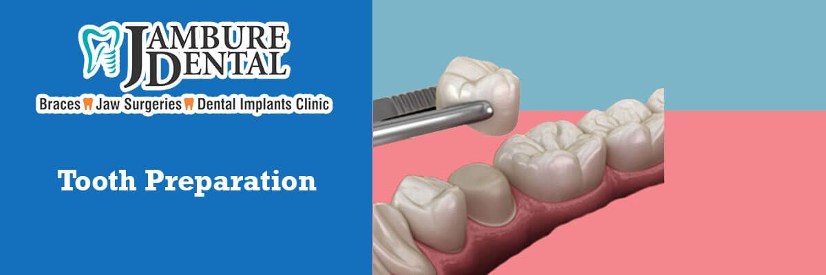  Tooth Preparation - JAMBURE DENTAL CLINIC