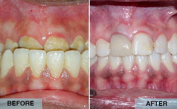 Surgical correction of large lower jaw with orthognathic surgery