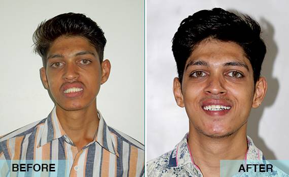 Surgical correction of large lower jaw with orthognathic surgery Surgical correction of large lower jaw with orthognathic surgery