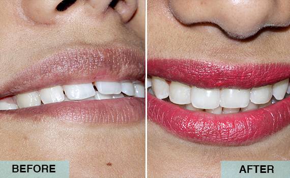 Smile Designing Smile Designing