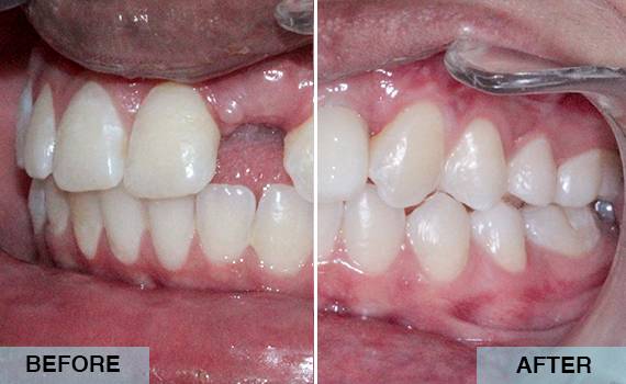 Dental implant Dental implant