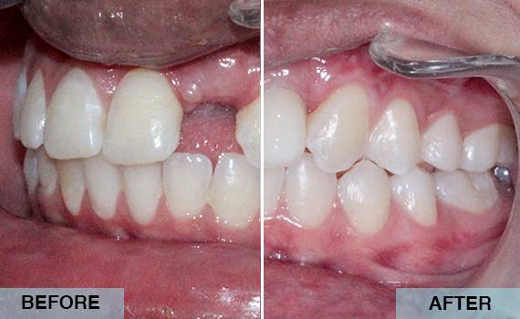 Dental implant