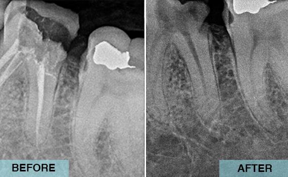 Root Canal Treatment- X-ray