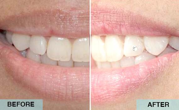 Tooth jewellery Tooth jewellery