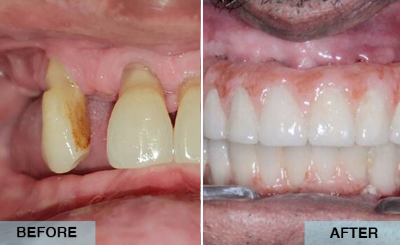 Full mouth rehabilitation with implants