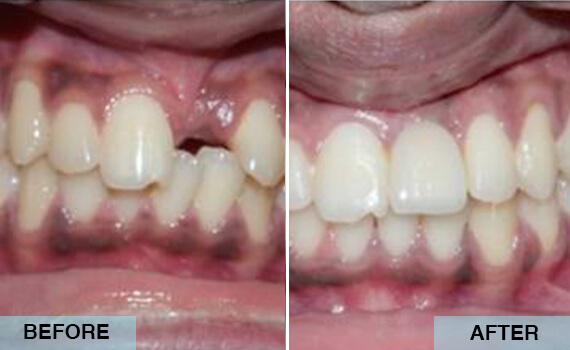 Single tooth replacement with implant Single tooth replacement with implant