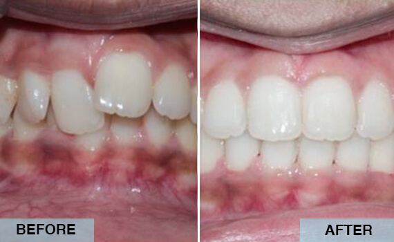 Orthodontic and Jaw surgery treatment