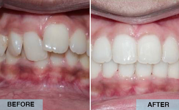 Orthodontic and Jaw surgery treatment Orthodontic and Jaw surgery treatment